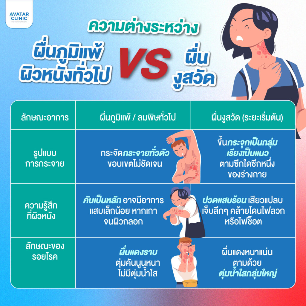 อินโฟกราฟิกเปรียบเทียบความแตกต่างระหว่างผื่นภูมิแพ้ผิวหนังทั่วไปกับผื่นงูสวัด ทั้งรูปแบบการกระจาย ความรู้สึกที่ผิวหนัง และลักษณะรอยโรค