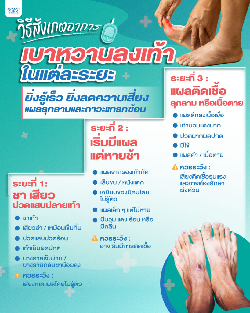 วิธีสังเกตอาการเบาหวานลงเท้า ในแต่ละระยะ ยิ่งรู้เร็ว ยิ่งลดความเสี่ยงแผลลุกลามและภาวะแทรกซ้อน