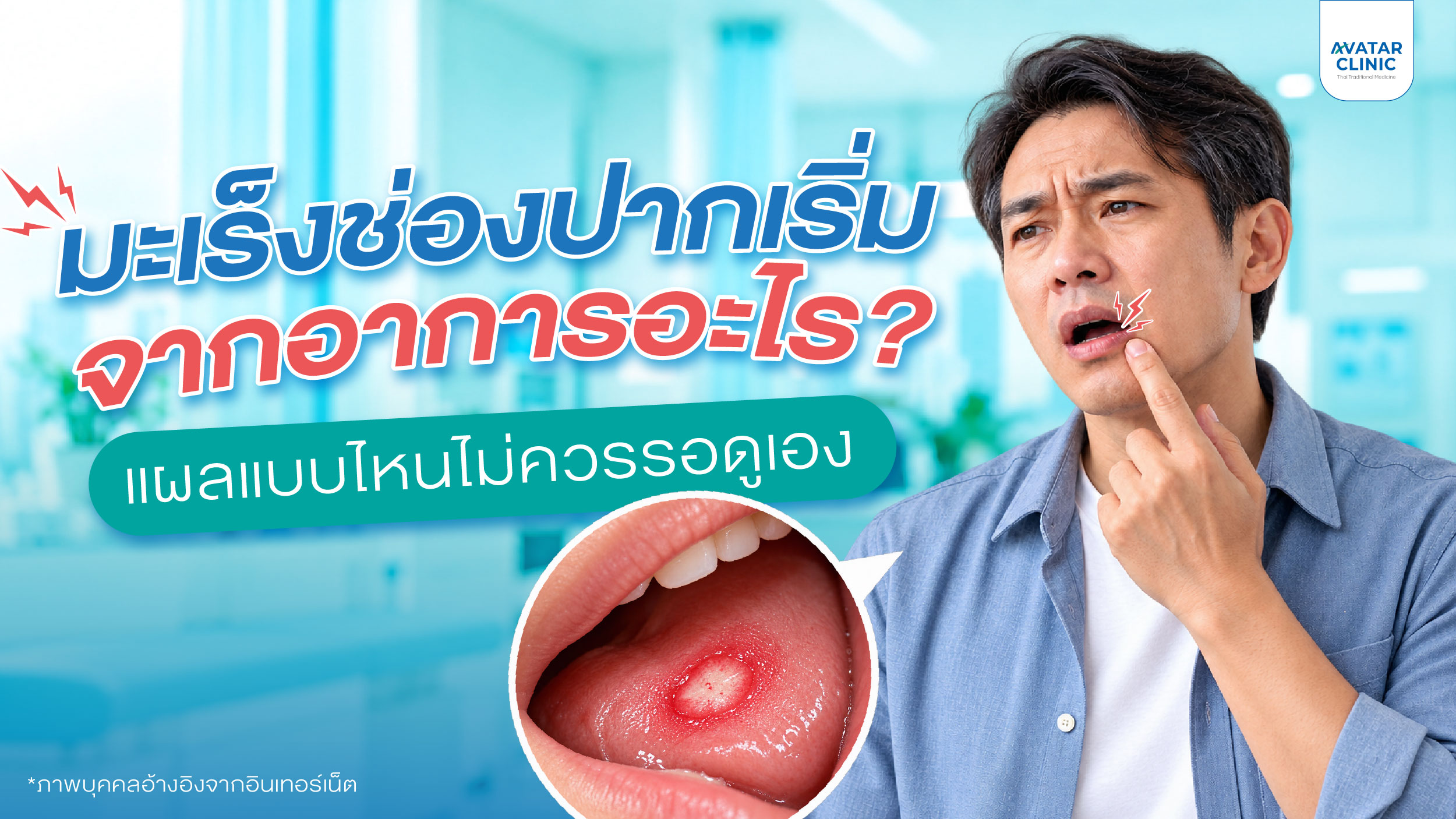 มะเร็งช่องปากเริ่มจากอาการอะไร? แผลแบบไหนไม่ควรรอดูเอง