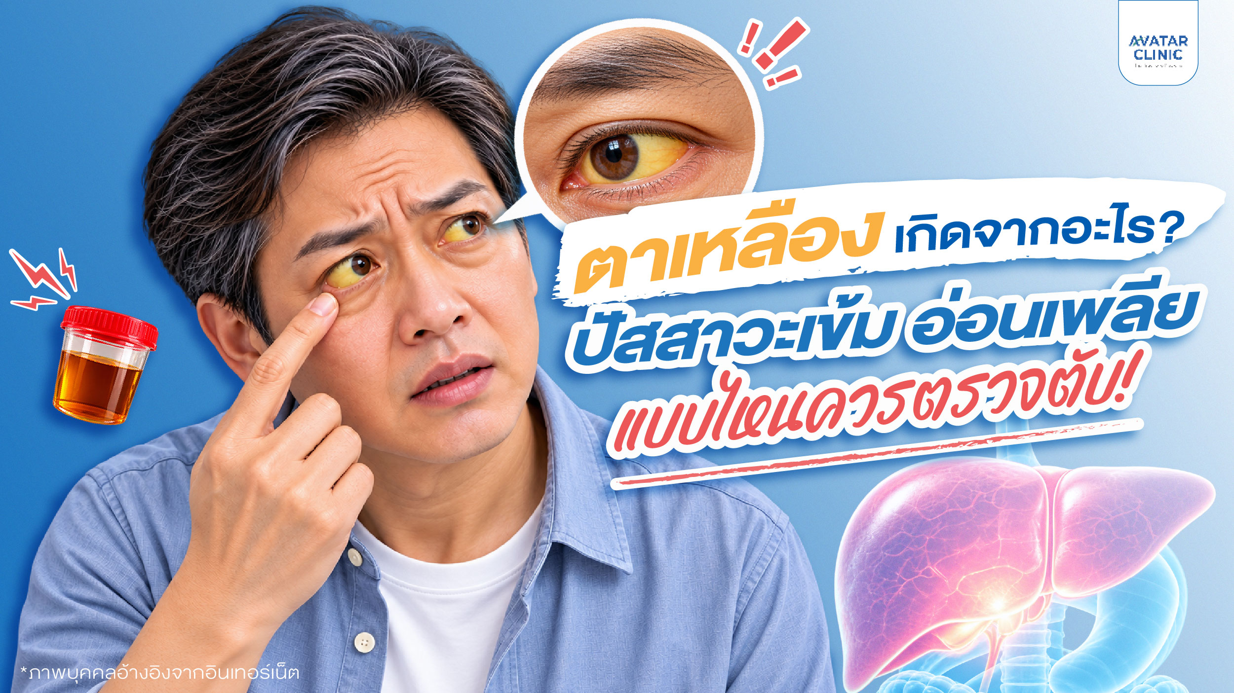 ตาเหลืองเกิดจากอะไร? ปัสสาวะเข้ม อ่อนเพลีย ควรตรวจตับหรือไม่