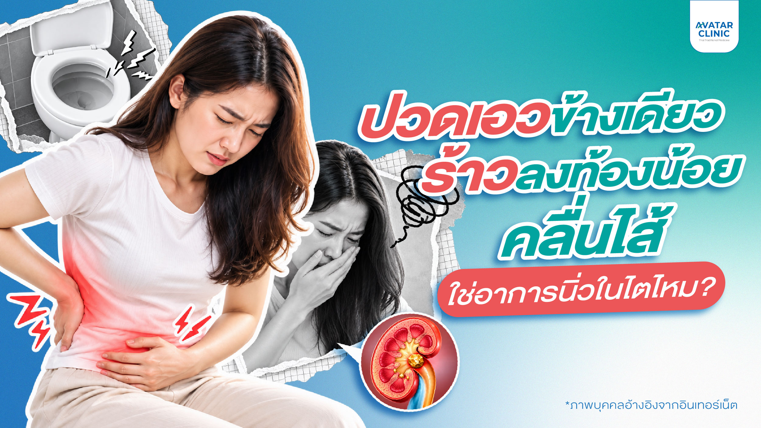 ปวดเอวข้างเดียว ร้าวลงท้องน้อย คลื่นไส้ ใช่อาการนิ่วในไตไหม?