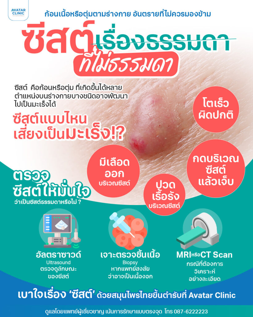 ซีสต์เรื่องธรรมดาที่ไม่ธรรมดา ซีสต์ หรือก้อนตุ่มที่เกิดขึ้นได้หลายตำแหน่งบนร่างกายบางชนิดอาจพพัฒนาไปเป็นมะเร็งได้