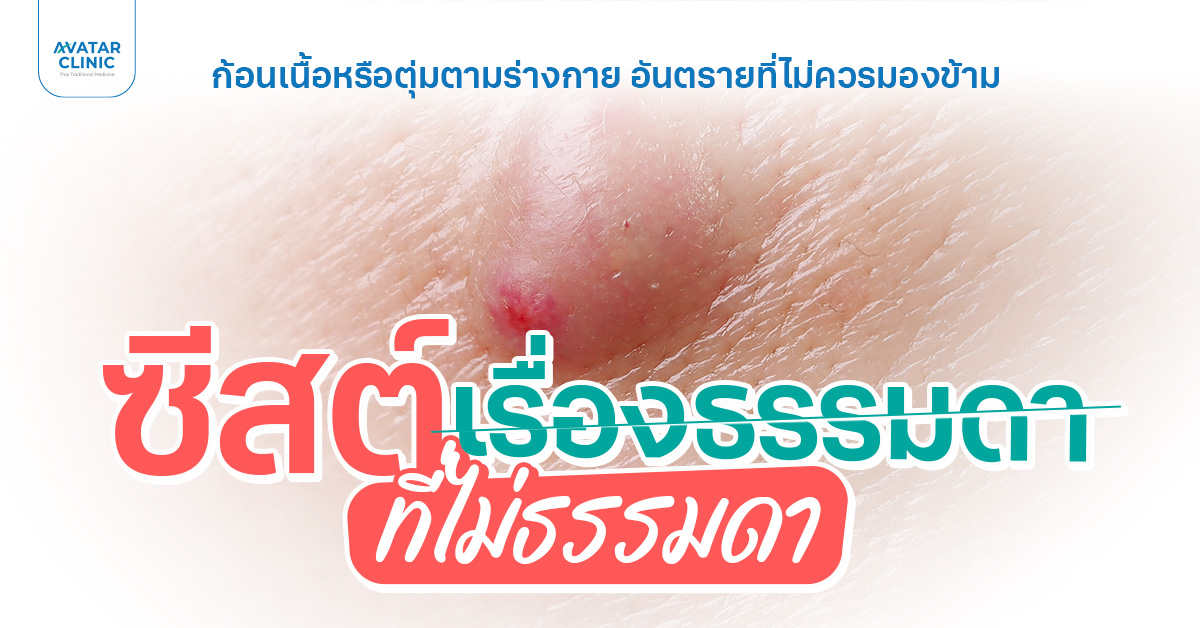 ซีสต์...เรื่องที่ต้องใส่ใจ อย่าปล่อยให้กลายเป็นเรื่องใหญ่