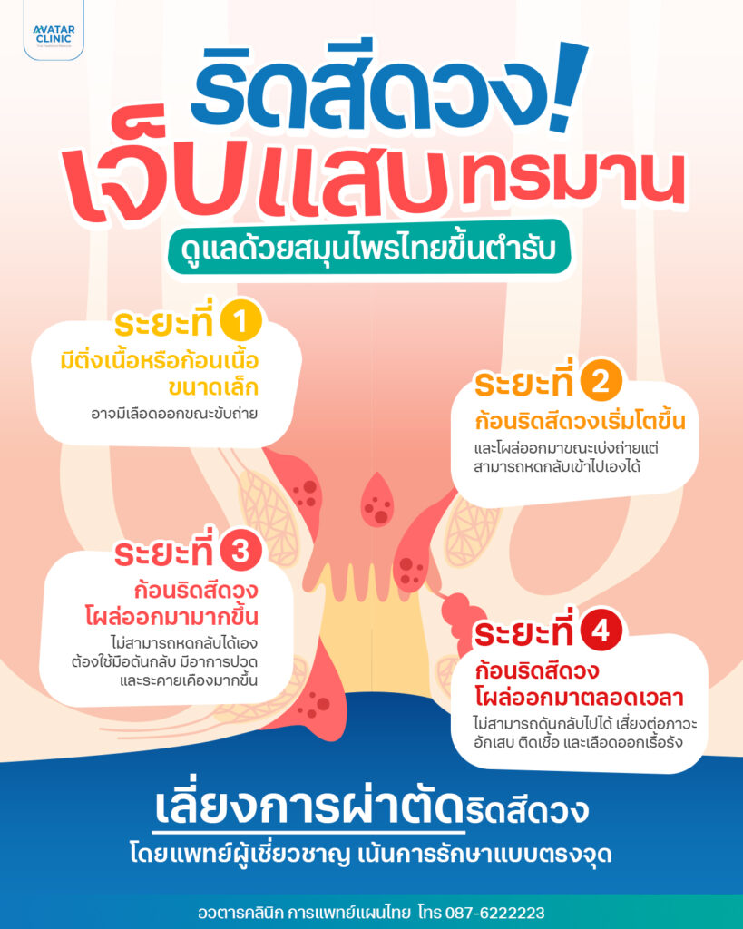ริดสีดวงเจ็บแสบทรมาน ดูแลด้วยสมุนไพรไทยขึ้นตำหรับ ระยะที่ 1 มีติ่งเนื้อหรือก้อนเนื้อขนาดเล็กอาจมีเลือดออกขณะขับถ่าย ระยะที่ 2 ก้อนริดสีดวงเริ่มโตขึ้น และโผล่ออกมาขณะเบ่งถ่ายแต่สามารถหดกลับเข้าไปเองได้ ระยะที่ 3 ก้อนริดสีดวงโผล่ออกมามากขึ้น ไม่สามารถหดกลับได้เองต้องใช้มือดันกลับ มีอาการปวดและระคายเคืองมากขึ้น ระยะที่ 4 ก้อนริดสีดวงโผล่ออกมาตลอดเวลา ไม่สามารถดันกลับไปได้ เสี่ยงต่อภาวะอักเสบ ติดเชื้อ และเลือดออกเรื้อรัง