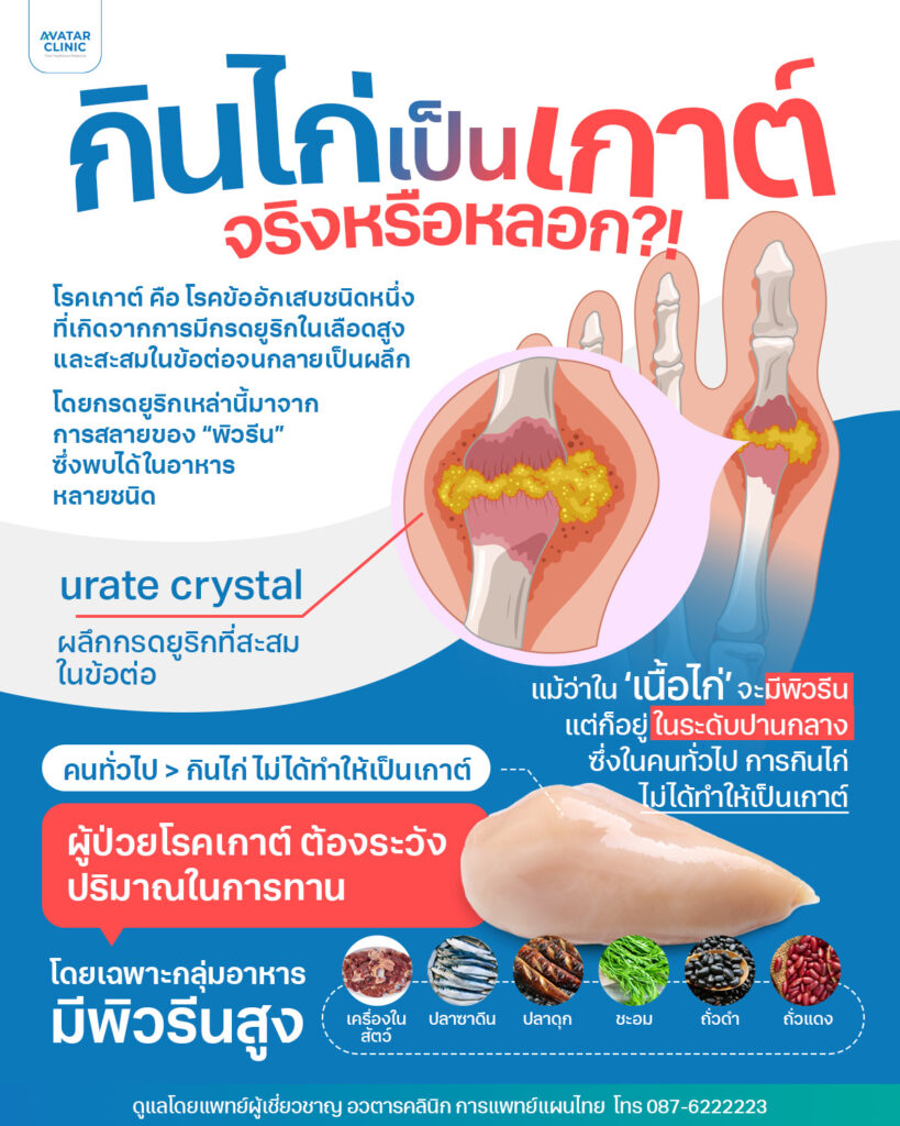 กินไก่เป็นเกาต์จริงหรือหลอก โรคเกาค์ คือโรคข้ออักเสบชนิดหนึง่ที่เกิดจากการมีกรดยูริกในเลือดสูงและสะสมในข้อต่อจนกลายเป็นผลึก โดย กรดยูริกเหล่านี้มาจากการสลายของพิวรีนซึ่งพบได้ในอาหารหลายชนิด