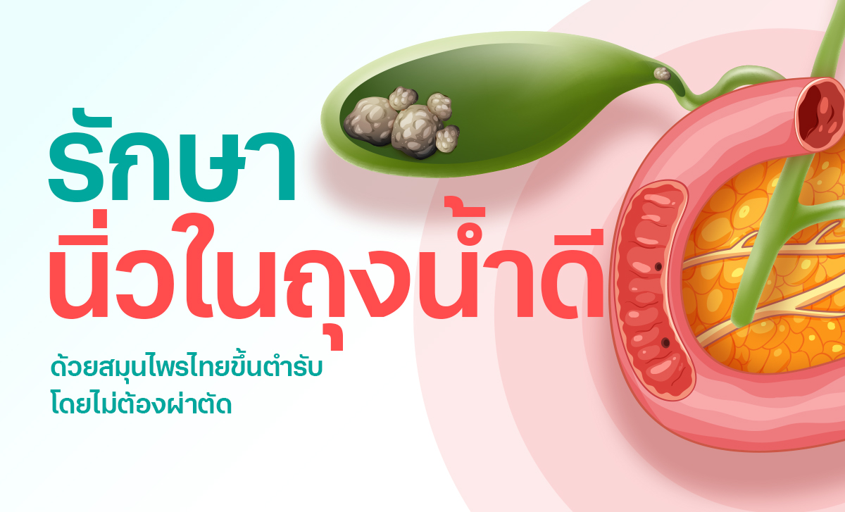 นิ่วในถุงน้ำดี ให้สมุนไพรไทยขึ้นตำรับเป็นทางเลือกก่อนการผ่าตัด