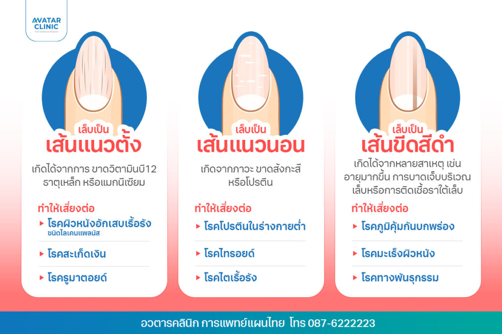 เส้นบนเล็บ
